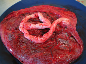 Placenta and cord